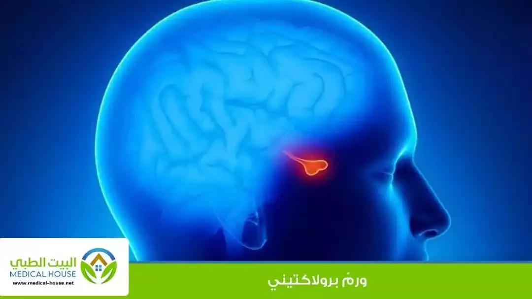 - ورمٌ برولاكتيني - ماهو، اسبابه العلاج