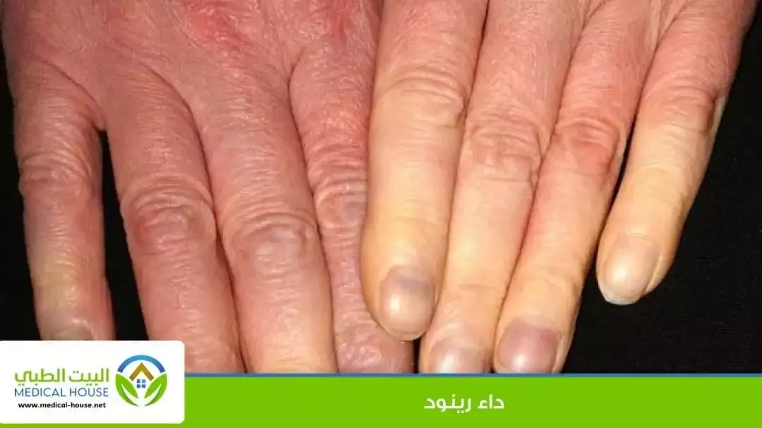 مرض رينود Raynaud's Disease - ما هو، أعراضه، التشخيص، العلاج والوقاية