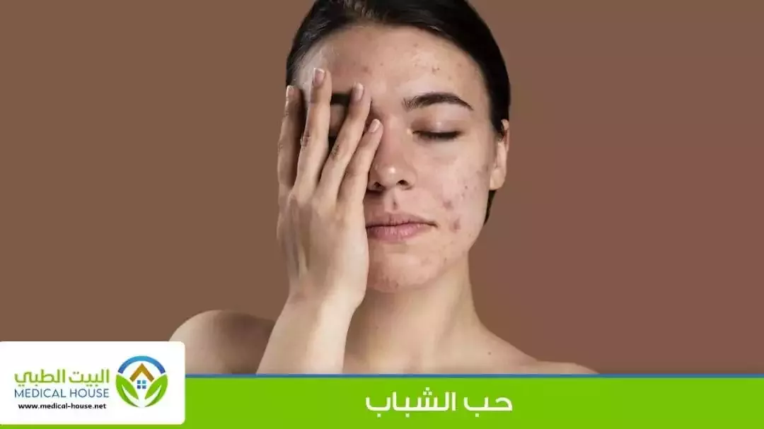 - ما هو، أعراضه ومظاهره، أسبابه، العلاج والوقاية