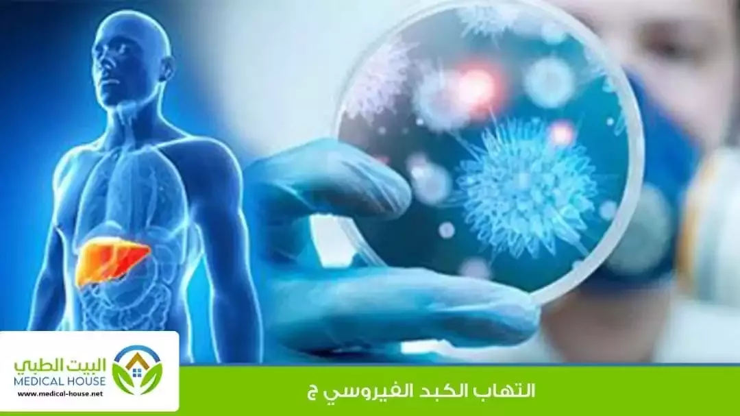 التهاب الكبد الفيروسي ج هو فيروس يصيب الكبد، وإذا تُرك دون علاج.