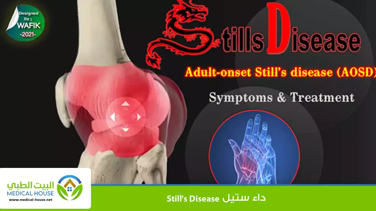 داء ستيل  يعرف باسم التهاب المفاصل الشبابي مجهول السبب وهو اضطراب جهازي