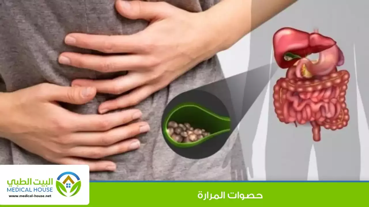 تتكون حصوات المرارة عندما يحدث تصلب للعصارة الصفراوية المخزنة في المرارة