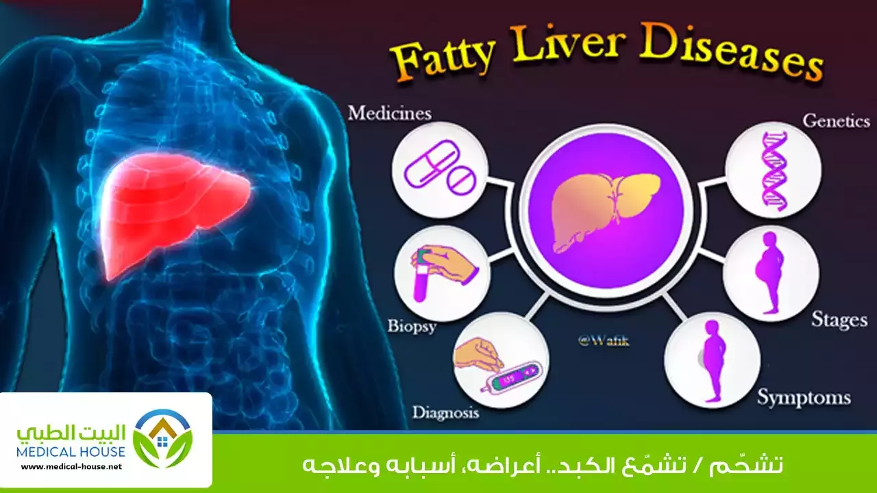 تشحم الكبد ثم تشمعه لاحقا او ما يطلق عليه الكبد الشحمية ـ د محمد وفيق ـ البيت الطبي