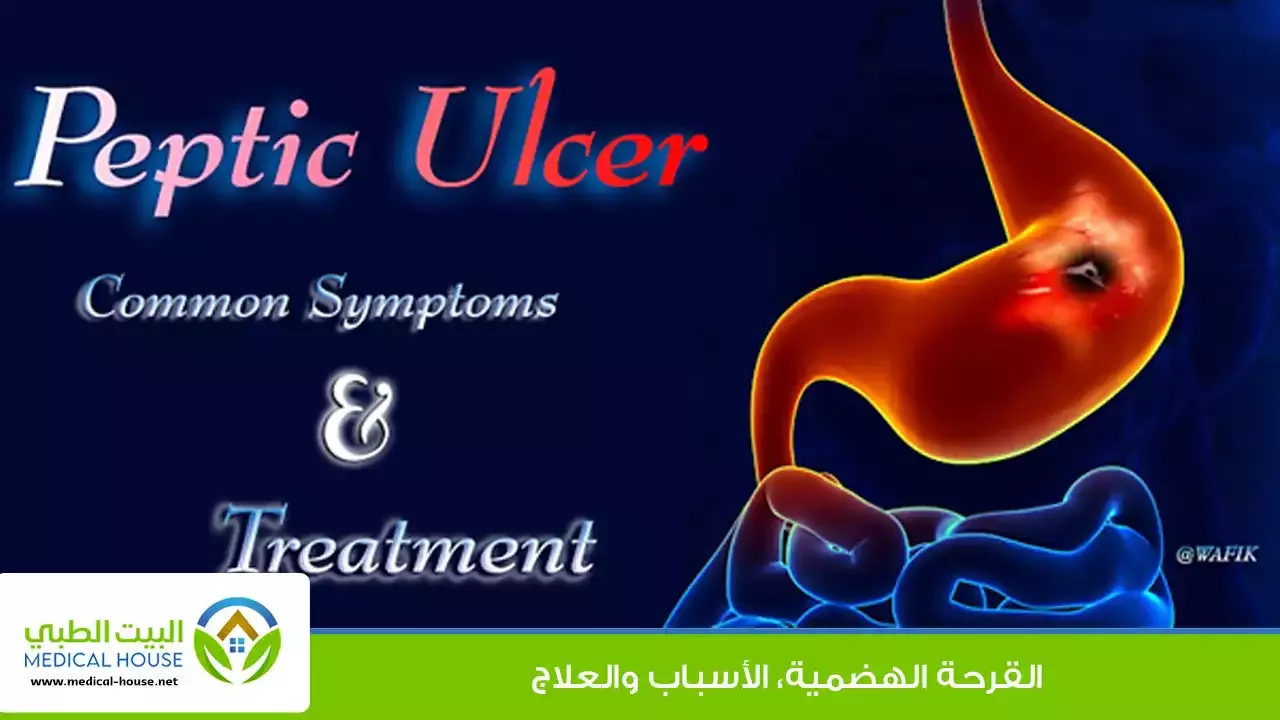 البيت الطبي ـ د / محمد وفيق ـ القرحة الهضمية (المعدية) ، الأسباب والعلاج