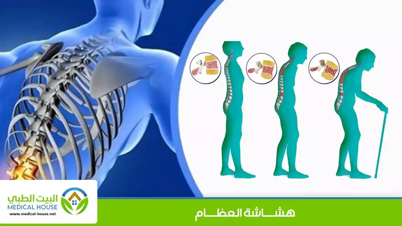 البيت الطبي ـ أسباب الإصابة بهشاشة العظام