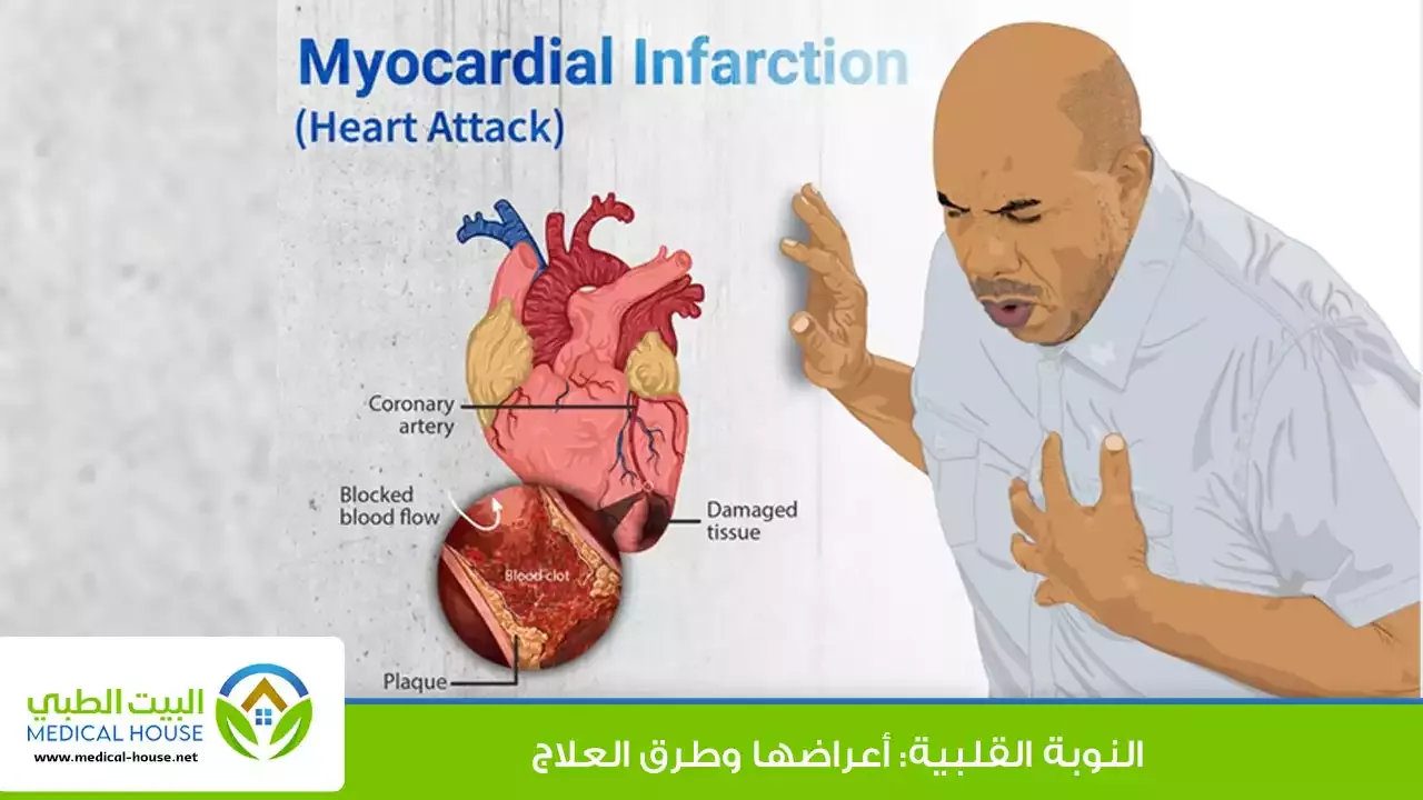 النوبة القلبية